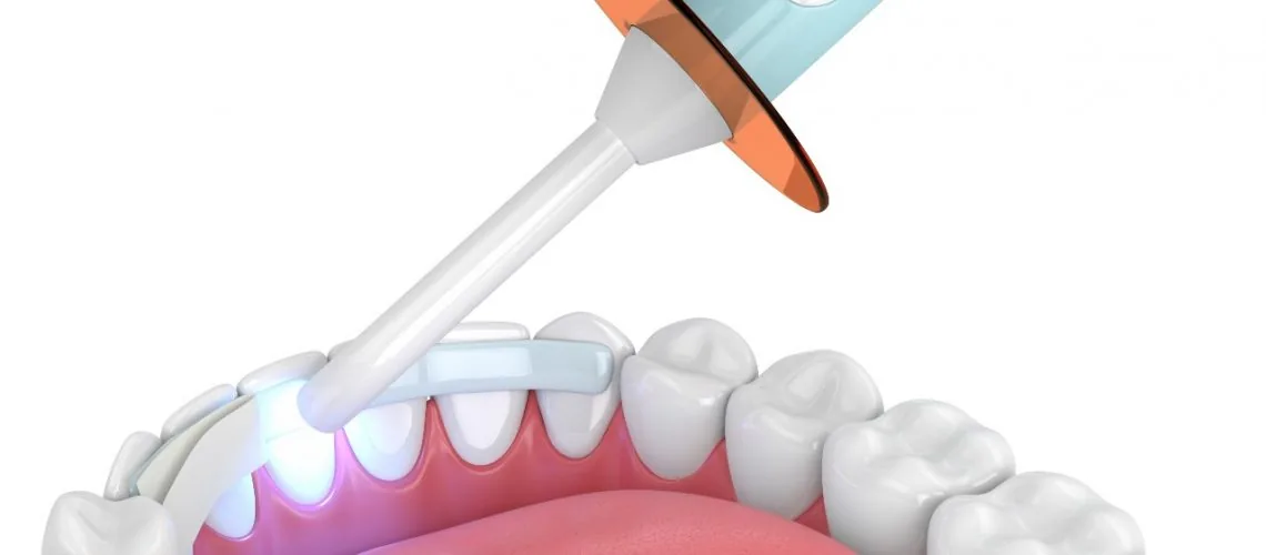 How Long Does Dental Bonding Last — Wicker Park Dental Studio, Chicago