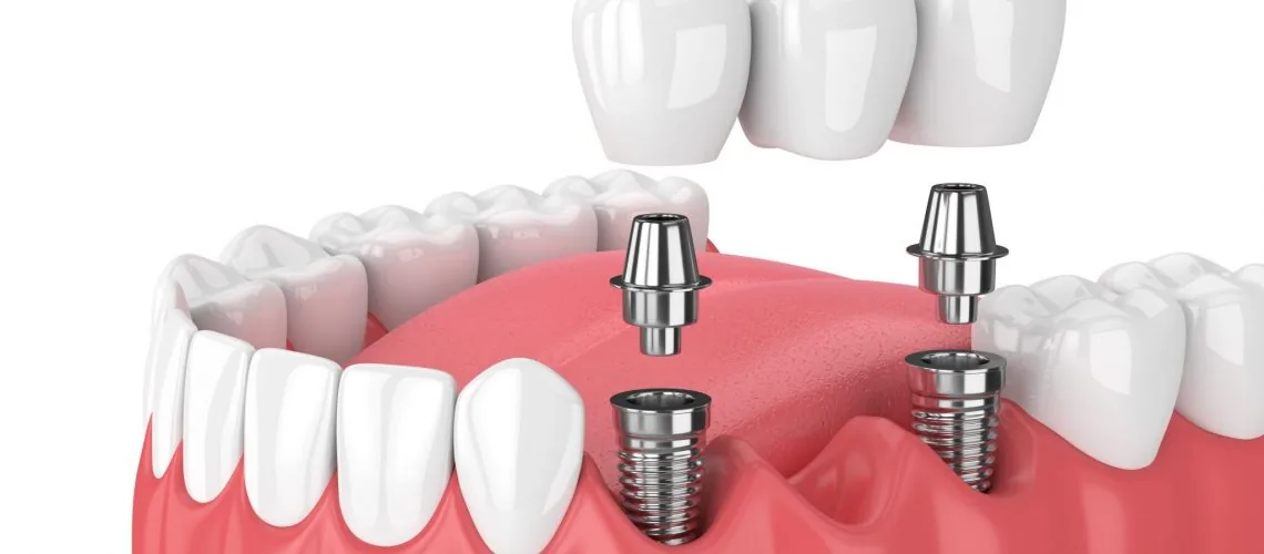 How Painful is the Dental Implant Process — Wicker Park Dental Studio, Chicago