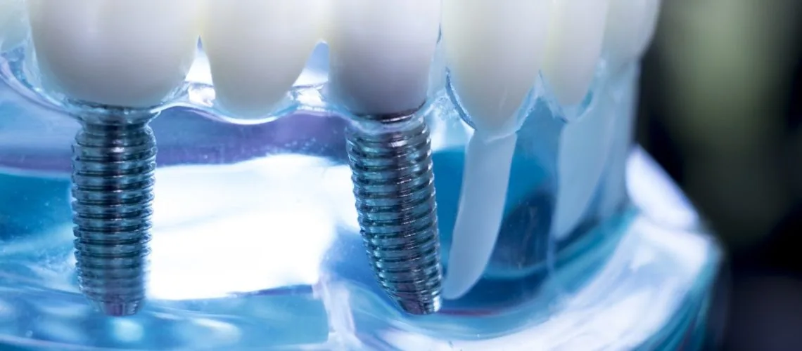 How To Choose the Right Dentist for Dental Implants — Wicker Park Dental Studio, Chicago