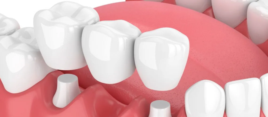 Smile Confidently Again with Dental Bridges — Wicker Park Dental Studio, Chicago
