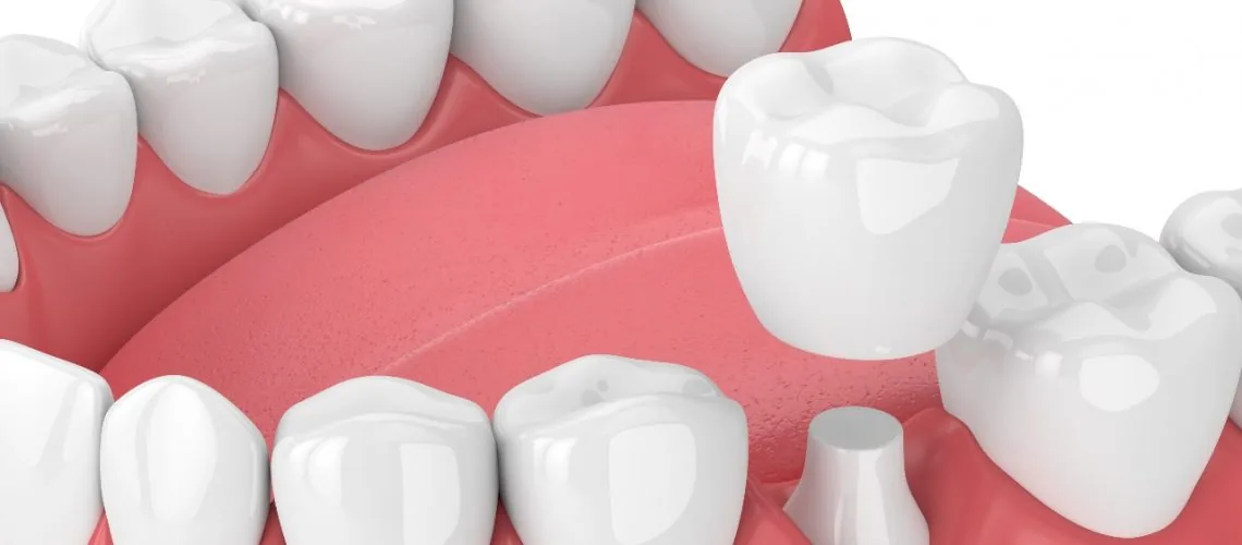 What are the Pros and Cons of Dental Crowns — Wicker Park Dental Studio, Chicago
