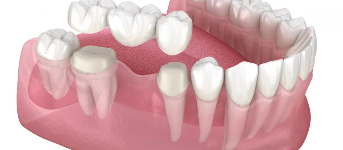 Why Should I Get a Dental Bridge — Wicker Park Dental Studio, Chicago